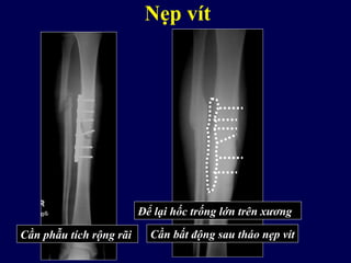 Nẹp vít
Cần phẫu tích rộng rãi
Để lại hốc trống lớn trên xương
Cần bất động sau tháo nẹp vít
 
