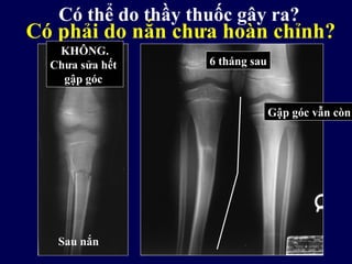Có thể do thầy thuốc gây ra?
6 tháng sau
Gập góc vẫn còn
Sau nắn
Có phải do nắn chưa hoàn chỉnh?
Acceptable??
KHÔNG.
Chưa sửa hết
gập góc
 
