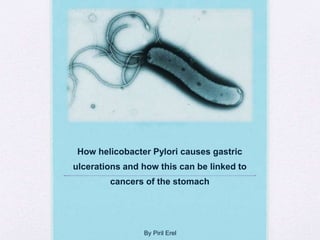 How helicobacter Pylori causes gastric
ulcerations and how this can be linked to
cancers of the stomach
By Piril Erel
 