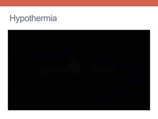 Hypothermia 
