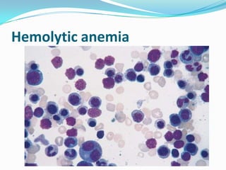 Hemolytic anemia
 