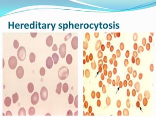 Hereditary spherocytosis
 