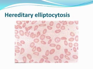 Hereditary elliptocytosis
 
