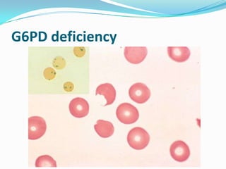 G6PD deficiency
 
