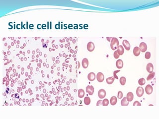 Sickle cell disease
 