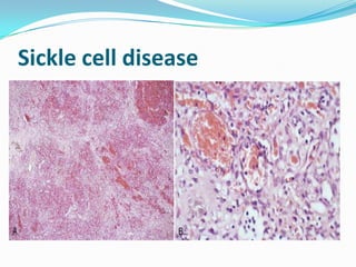 Sickle cell disease
 