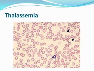 Thalassemia
 