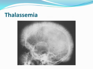 Thalassemia
 