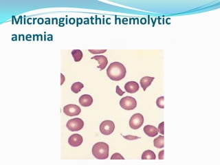 Microangiopathic hemolytic
anemia
 