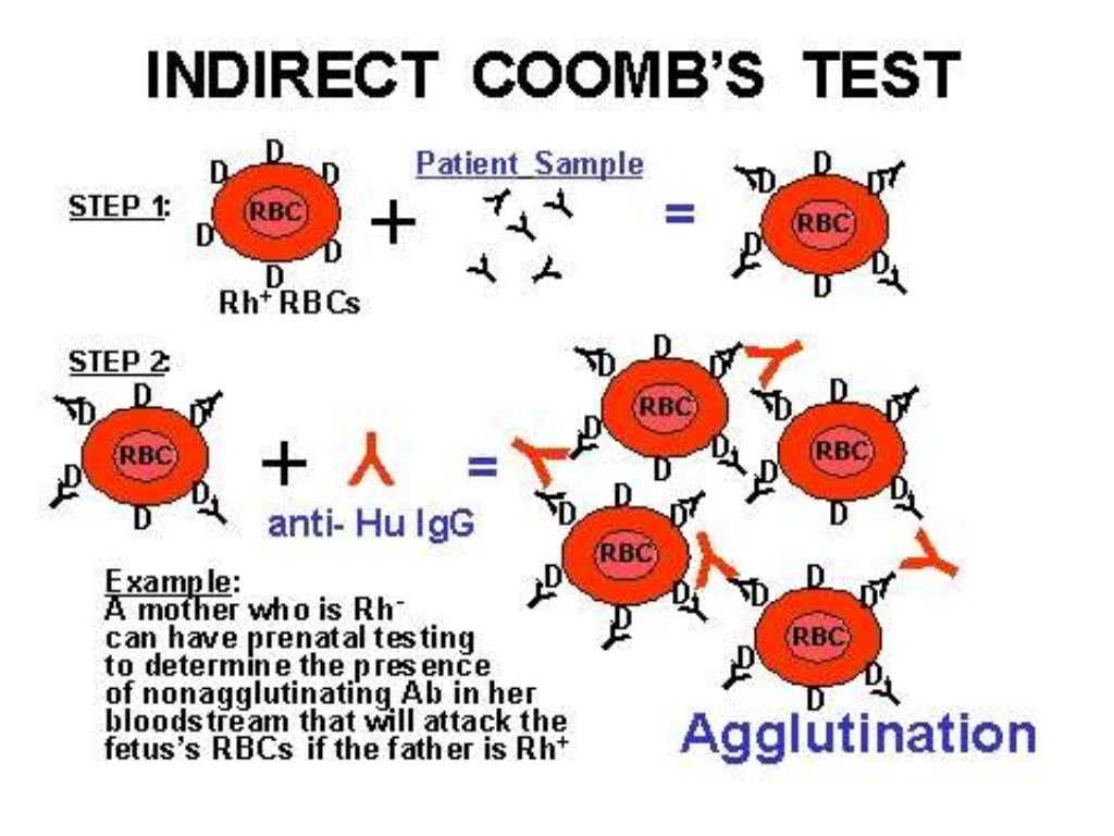 Hemolytic Anemia Investigation By Mohan kumar