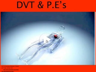 DVT & P.E’s




DVT & Pulmonary Embolism. Prevent
DVT. Web. 29 Mar. 2011.
  <http://www.preventdvt.org/media/
dvt-videos/glassman.aspx>.
 