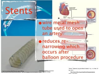 Stents
                                                                                                •wire metal mesh
                                                                                                           tube used to open
                                                                                                           an artery
                                                                                                •reduces re-
                                                                                                           narrowing which
                                                                                                           occurs after
                                                                                                           balloon procedure

                                                                                                                                            "Stents." National Lung and Blood Institute . N.p., n.d. Web. 24

                                                                                                       http://www.medgadget.com/archives/   Feb. 2011.
  http://www.topnews.in/ﬁles/Medicated_Stents.2007.jpg
http://www.topnews.in/ﬁles/Medicated_Stents.2007.jpg   http://www.medgadget.com/archives/img/Stent---side.jpg   img/Stent---side.jpg           <http://www.nhlbi.nih.gov/health/dci/Diseases/stents/
 