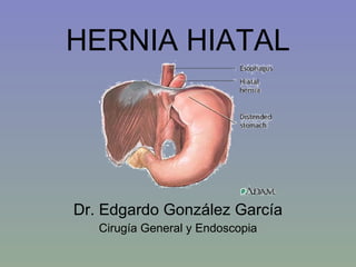 HERNIA HIATAL Dr. Edgardo González García Cirugía General y Endoscopia 