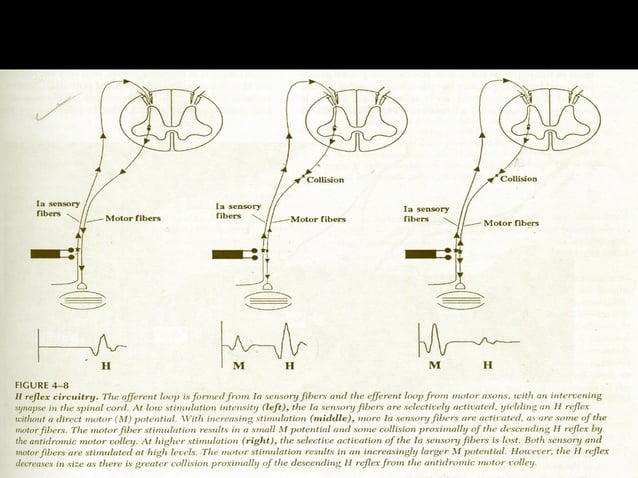 H reflex (Hoffmann's Reflex)