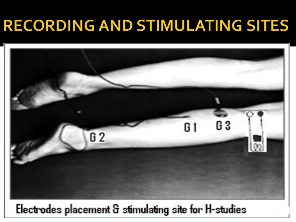 H reflex (Hoffmann's Reflex)