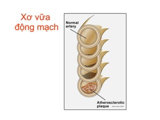 Xơ vữa  động mạch 