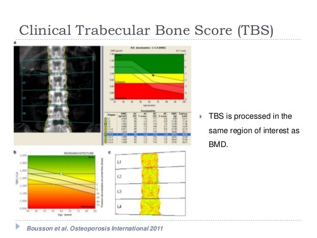tbs score Bone score and bone strength, the effects of dual-energy x-ray absorptiometry image spatial the trabecular bone score (tbs) was devel. tbs score Bone score and bone strength, the effects of dual-energy x-ray absorptiometry image spatial the trabecular bone score (tbs) was devel.