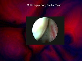 Cuff Inspection, Partial Tear
 