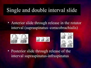 Single and double interval slide
• Anterior slide through release in the rotator
interval (supraspinatus–coracobrachialis)...