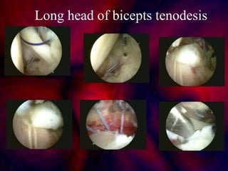 Long head of bicepts tenodesis
 