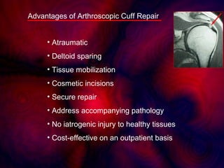 Advantages of Arthroscopic Cuff Repair
• Atraumatic
• Deltoid sparing
• Tissue mobilization
• Cosmetic incisions
• Secure ...
