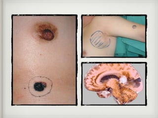 Diagnóstico
Las lesiones benignas presentan
pigmentación uniforme; su superﬁcie,
que puede ser lisa, polipoideo
verrugosa,...