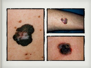 Melanoma
Nodular
• Es un tumor saliente de superﬁcie lisa o
vegetante, de color negro o azuloso, que
carece de la pigmenta...