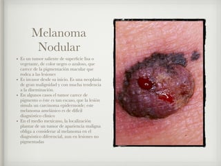 Melanoma Acral
Lentiginoso
• En su inicio son lesiones maculares
con pigmentación irregular de
diversas tonalidades que se...