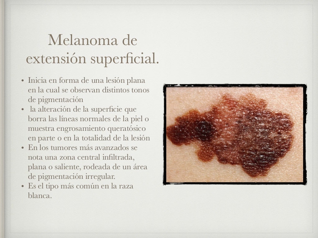 Melanoma