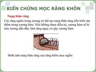 LOGO
Nang thân răng
Các răng ngầm trong xương có thể tạo nang thân răng tiến triển âm
thầm trong xương hàm. Nếu không được điều trị, xương hàm sẽ bị
tiêu xương dần dần, làm tăng nguy cơ gãy xương hàm.
Hình ảnh nang thân răng của răng khôn mọc ngầm
BIẾN CHỨNG MỌC RĂNG KHÔN
 
