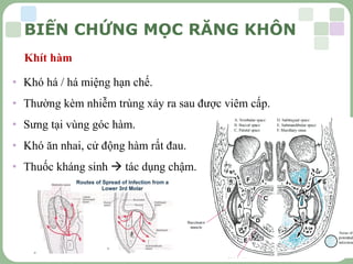 LOGO
Khít hàm
• Khó há / há miệng hạn chế.
• Thường kèm nhiễm trùng xảy ra sau được viêm cấp.
• Sưng tại vùng góc hàm.
• Khó ăn nhai, cử động hàm rất đau.
• Thuốc kháng sinh  tác dụng chậm.
BIẾN CHỨNG MỌC RĂNG KHÔN
 