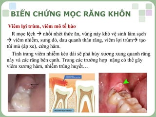 LOGO
BIẾN CHỨNG MỌC RĂNG KHÔN
Viêm lợi trùm, viêm mô tế bào
R mọc lệch  nhồi nhét thức ăn, vùng này khó vệ sinh làm sạch
 viêm nhiễm, sưng đỏ, đau quanh thân răng, viêm lợi trùm tạo
túi mủ (áp xe), cứng hàm.
Tình trạng viêm nhiễm kéo dài sẽ phá hủy xương xung quanh răng
này và các răng bên cạnh. Trong các trường hợp nặng có thể gây
viêm xương hàm, nhiễm trùng huyết…
 