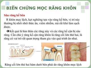 LOGO
Sâu răng kế bên
R khôn mọc lệch, kẹt nghiêng tựa vào răng kế bên, vị trí này
thường bị nhồi nhét thức ăn, viêm nhiễm, mà rất khó làm sạch
được.
Kết quả là bản thân các răng này và các răng kế cận bị sâu
răng. Cần chú ý răng kế cận răng khôn là răng cối lớn thứ hai, là
răng có vai trò rất quan trọng tham gia vào quá trình ăn nhai.
Răng cối lớn thứ hai hàm dưới bên phải do răng khôn mọc lệch

BIẾN CHỨNG MỌC RĂNG KHÔN
 