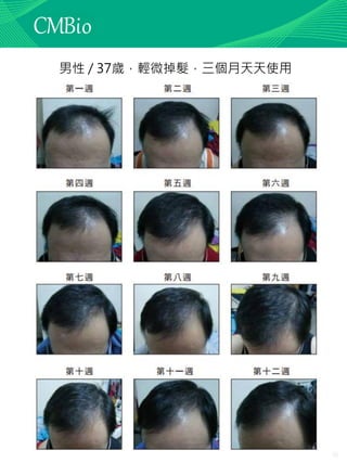 僅供教育訓練使用
男性 / 37歲，輕微掉髮，三個月天天使用
 