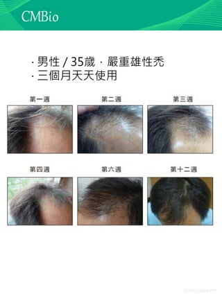 僅供教育訓練使用
‧ 男性 / 35歲，嚴重雄性禿
‧ 三個月天天使用
 