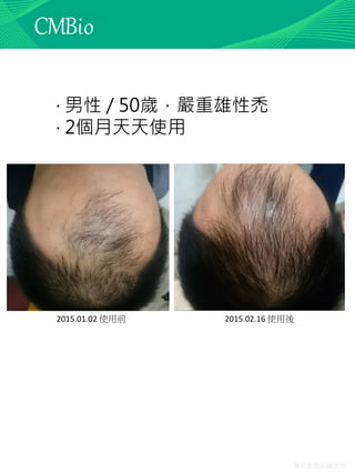 僅供教育訓練使用
2015.01.02 使用前 2015.02.16 使用後
‧ 男性 / 50歲，嚴重雄性禿
‧ 2個月天天使用
 