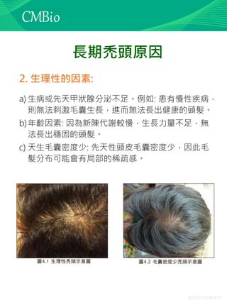 僅供教育訓練使用
長期禿頭原因
2. 生理性的因素:
a) 生病或先天甲狀腺分泌不足。例如: 患有慢性疾病，
則無法刺激毛囊生長，進而無法長出健康的頭髮。
b)年齡因素: 因為新陳代謝較慢，生長力量不足，無
法長出穩固的頭髮。
c) 天生毛囊密度少: 先天性頭皮毛囊密度少，因此毛
髮分布可能會有局部的稀疏感。
 