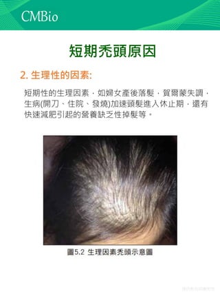 僅供教育訓練使用
2. 生理性的因素:
短期性的生理因素，如婦女產後落髮，賀爾蒙失調，
生病(開刀、住院、發燒)加速頭髮進入休止期，還有
快速減肥引起的營養缺乏性掉髮等。
短期禿頭原因
 