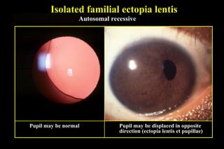 Isolated familial ectopia lentis
Autosomal recessive
Pupil may be normal Pupil may be displaced in opposite
direction (ectopia lentis et pupillae)
 