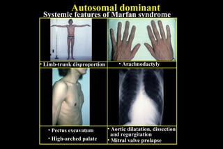 Autosomal dominant
Systemic features of Marfan syndrome
• Limb-trunk disproportion • Arachnodactyly
• Pectus excavatum
• High-arched palate
• Aortic dilatation, dissection
and regurgitation
• Mitral valve prolapse
 