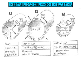 INESTABILIDAD DEL VASO SIN ELASTINA 