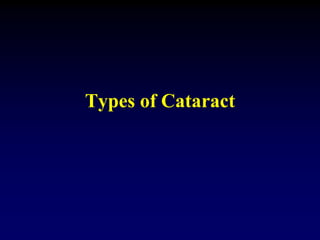 H2 - Congenital & Developmental Cataract.ppt
