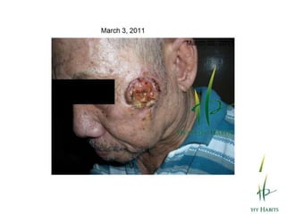 The Elements of Wheatgrass and Barley GrassChlorophyllChlorophyll lowers high blood pressure by enhancing blood flow through the capillaries.Chlorophyll is a detoxification agent. Studies have shown that the detoxifying property of 350 pounds of the best vegetables is equivalent to only 15 pounds of wheatgrass. Chlorophyll purifies the liver, neutralizes toxins, and removes drug deposits and heavy metals from the body.Chlorophyll has antibacterial action. It has been known to heal infected and ulcerated wounds, as well as cure chronic infections and inflammations. 