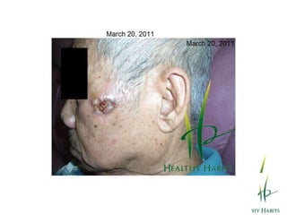 The Effects of Wheatgrass and Barley GrassHYPERTENSION- 	Chlorophyll lowers cholesterol, triglycerides and LDL.The enzymes fatty acid oxidase, peroxidase, catalase, cytochromeoxidase and transhydrogenase decompose fat.