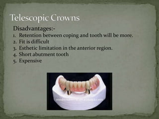Ast Coping Tooth Periodontally Compromised Dentiition | PPTX