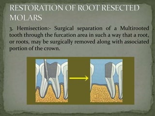 Tooth Hemisection Periodontally Compromised Dentiition | PPTX