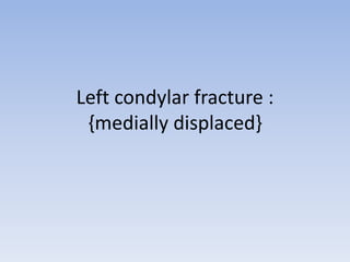 Left condylar fracture :
{medially displaced}
 