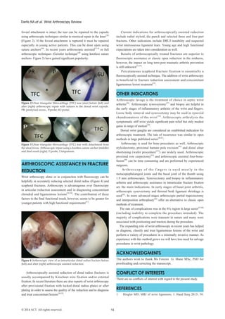 54© 2014 ACT. All rights reserved.
Darlis NA et al. Wrist Arthroscopy Review
foveal attachment is intact the tear can be repaired to the capsule
using arthroscopic techniques similar to meniscal repair in the knee[26]
(Figure 2). If the foveal attachment is ruptured it must be repaired
especially in young active patients. This can be done open using
suture anchors[26]
. In recent years arthroscopic assisted[27,4]
or full
arthroscopic techniques (Geissler technique[28]
using knotless suture
anchors- Figure 3) have gained significant popularity.
Figure 2 Ulnar triangular fibrocartilage (TFC) tear (star) before (left) and
after (right) arthroscopic repair with sutures to the dorsal wrist capsule.
PR: prestyloid recess ; P:probe; 6U:portal.
Figure 3 Ulnar triangular fibrocartilage (TFC) tear with detachment from
the ulnar fovea. Arthroscopic repair using a knotless suture anchor (middle)
and final result (right). P:probe; T:triquetrum.
ARTHROSCOPIC ASSISTANCE IN FRACTURE
REDUCTION
Wrist arthroscopy alone or in conjunction with fluoroscopy can be
helpfully in accurately reducing selected distal radius (Figure 4) and
scaphoid fractures. Arthroscopy is advantageous over fluoroscopy
in articular reduction assessment and in diagnosing concomitant
chondral and ligamentous lesions[29,30]
. The contribution of these
factors to the final functional result, however, seems to be greater for
younger patients with high functional requirements[31]
.
Figure 4 Arthroscopic view of an intrarticular distal radius fracture before
(left) and after (right) arthroscopic assisted reduction.
Arthroscopically assisted reduction of distal radius fractures is
usually accompanied by Kirschner wire fixation and/or external
fixation. In recent literature there are also reports of wrist arthroscopy
after provisional fixation with locked distal radius plates or after
plating in order to assess the quality of the reduction and to diagnose
and treat concomitant lesions[30,32]
.
Current indications for arthroscopically assisted reduction
include radial styloid, die punch and selected three and four part
fractures. Other indications include DRUJ instability and suspected
wrist interosseous ligament tears. Young age and high functional
expectations are taken into consideration as well.
Results of arthroscopically treated fractures are superior to
fluoroscopic assistance or classic open reduction in the midterm,
however, the impact on long term post traumatic arthritis prevention
is still unknown[33,34]
.
Percutaneous scaphoid fracture fixation is essentially a
fluoroscopically assisted technique. The addition of wrist arthroscopy
is beneficial in fracture reduction assessment and concomitant
ligamentous lesion treatment[35]
.
OTHER INDICATIONS
Arthroscopic lavage is the treatment of choice in septic wrist
arthritis[36]
. Arthroscopic synovectomy[37]
and biopsy are helpful in
the early stages of inflammatory arthritis of the wrist and fingers.
Loose body removal and synovectomy may be used in synovial
chondromatosis of the wrist[38]
. Arthroscopic arthrolysis the
symptomatic stiff wrist yields significant pain relief but only modest
gains in range of motion[39]
.
Dorsal wrist ganglia are considered an established indication for
arthroscopic treatment. The rate of recurrence was similar to open
methods in large published series[40,41]
.
Arthroscopy is used for bone procedures as well. Arthroscopic
styloidectomy, proximal hamate pole excision[42]
and distal ulnar
shortening (wafer procedure[23]
) are widely used. Arthroscopic
proximal row carpectomy[43]
and arthroscopic assisted four-bone-
fusion[44]
can be time consuming and are performed by experienced
surgeons.
Arthroscopy of the fingers is used mostly in the
metacapophalangeal joints and the basal joint of the thumb using
1.9 mm arthroscopes. Synovectomy and biopsy in inflammatory
arthritis and arthroscopic assistance in intrarticular fracture fixation
are the main indications. In early stages of basal joint arthritis,
arthroscopic synovectomy and thermal beak ligament shrinkage is
used[45]
. In more advanced stages arthroscopic partial trapeziectomy
and interposition arthroplasty[46]
offer an alternative to classic open
methods of treatment.
The rate of complications was in the 6% region in large series[47,48]
(including inability to complete the procedure intended). The
majority of complications were transient in nature and many were
associated with positioning and traction during the procedure.
The expanding role of wrist arthroscopy in recent years has helped
us diagnose, classify and treat ligamentous lesions of the wrist and
perform a variety of procedures in a minimally invasive manner. As
experience with this method grows we will have less need for salvage
procedures in wrist pathology.
ACKNOWLEDGMENTS
The authors wish to thank Ms Foteini G. Mane MSc, PhD for
proofreading and correcting the manuscript.
CONFLICT OF INTERESTS
There are no conflicts of interest with regard to the present study.
REFERENCES
1.	 Ringler MD. MRI of wrist ligaments. J. Hand Surg 2013; 38:
 