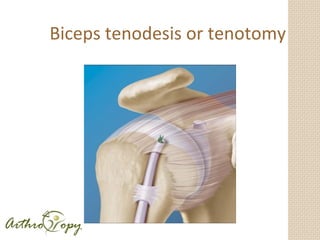 New developments in shoulder arthroscopy | PPT