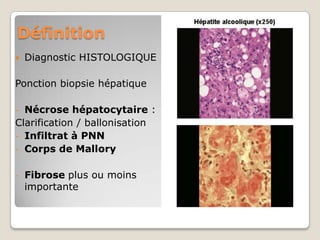 Définition
   Diagnostic HISTOLOGIQUE

Ponction biopsie hépatique

- Nécrose hépatocytaire :
Clarification / ballonisation
- Infiltrat à PNN
- Corps de Mallory


-   Fibrose plus ou moins
    importante
 
